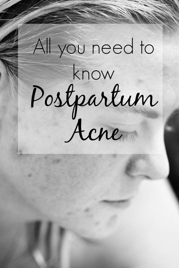 All you need to know about postpartum acne